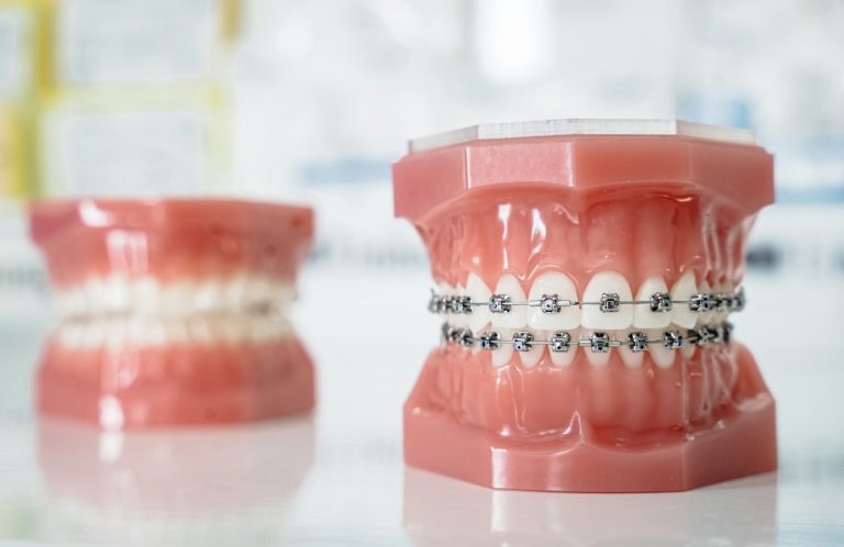 Zwei kieferorthopädische Modelle mit Brackets und Zähnen auf einem Tisch.